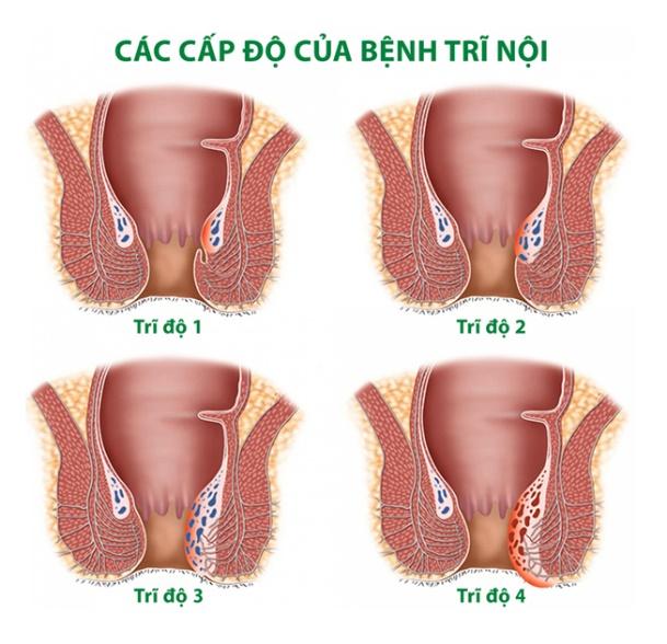 Phân độ bệnh trĩ